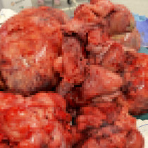 45 yaşındaki kadından çıkarıldı: Tam 60 santimetre çapında, 17 kilogram ağırlığında!