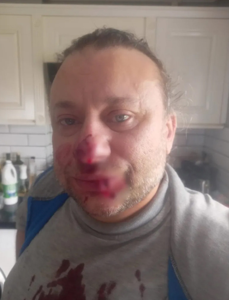 Ünlü isim pitbul saldırısına uğradı; burnu parçalandı! - Resim : 2