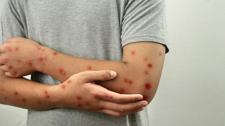 Çocukluk hastalığı geri döndü! Kızamık vakaları korkutuyor - Resim : 2