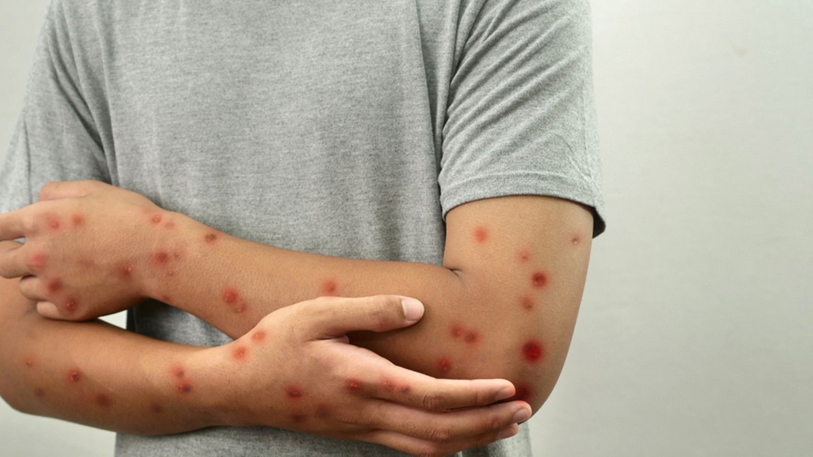 Acilen aşı yaptırılmalı, maymun çiçeği Türkiye'de var mı?