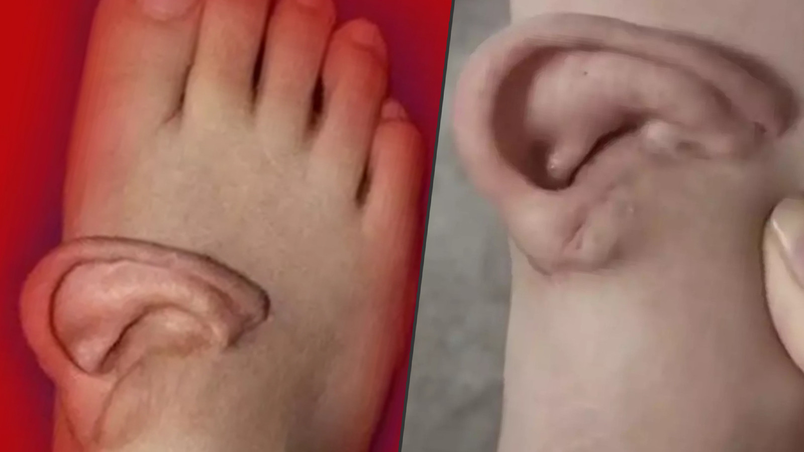 Eşi benzeri olmayan acayip bir olay: Kulağını 5 ay ayağında taşıdı