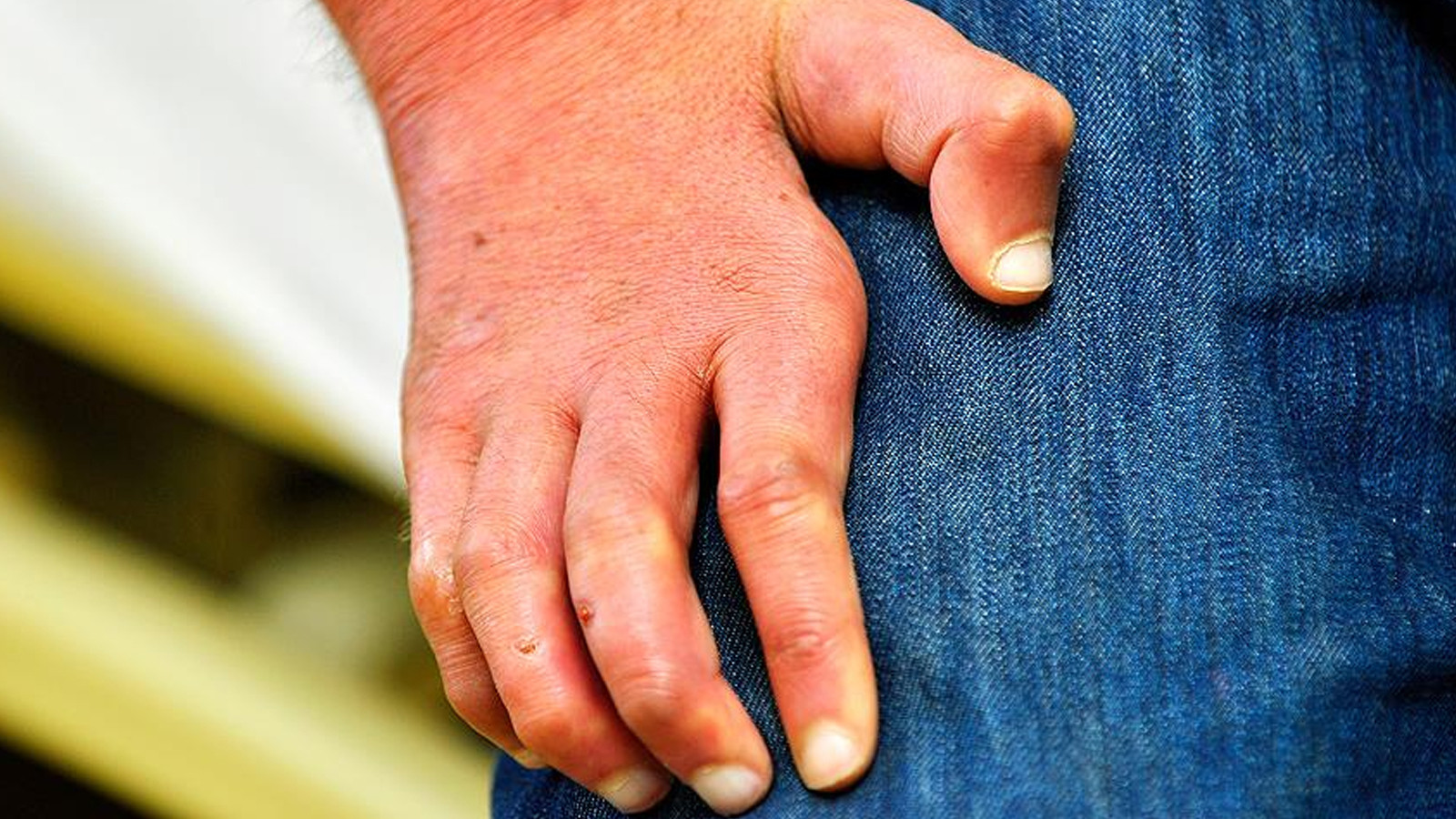 Hırvatistan 32, Romanya’da 44 yıl aradan sonra ilk kez cüzzam görüldü