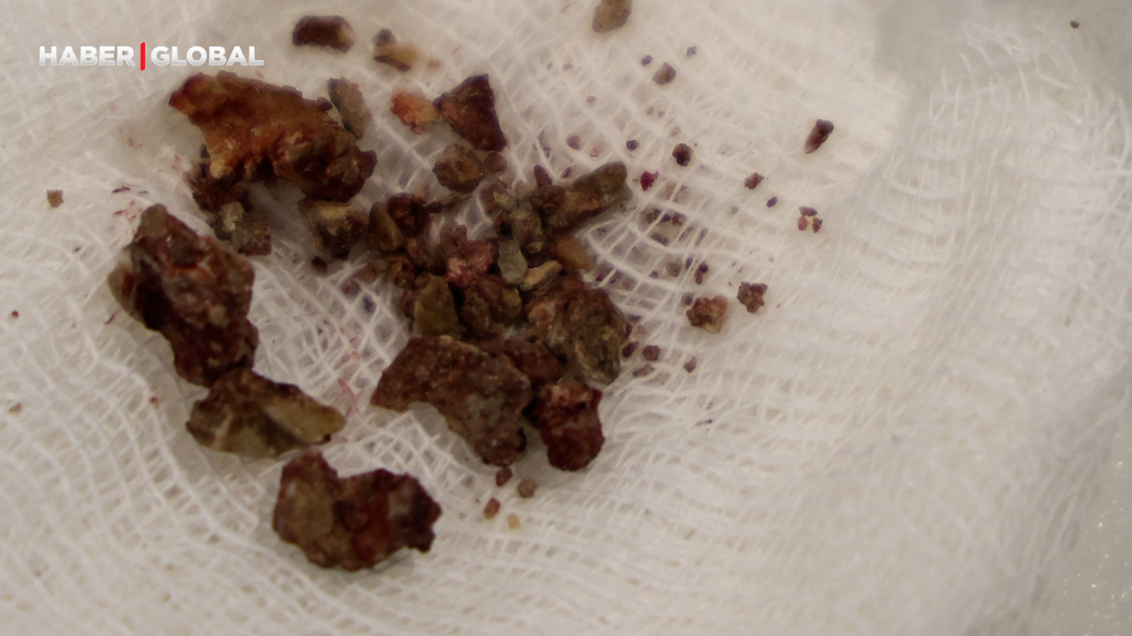 Elazığ’da estetik ameliyatta doktorları şaşırtan olay, burnundan taşlar çıktı!