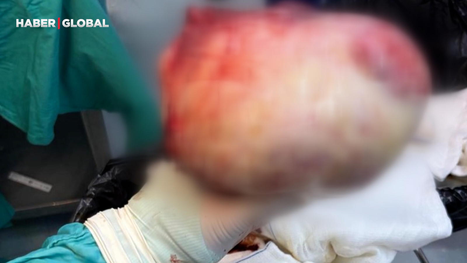 60 yaşındaki kadının şişen karnından çıkanlar şoke etti! Tam 6 kilo