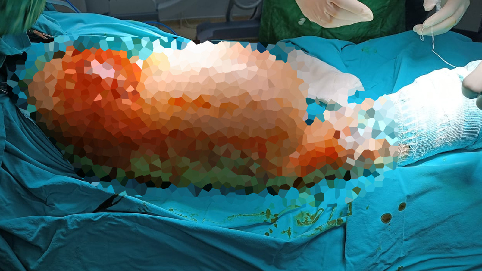 Hastanın bacağından çıkan şoke etti: Tam 5 kilo 668 gram!