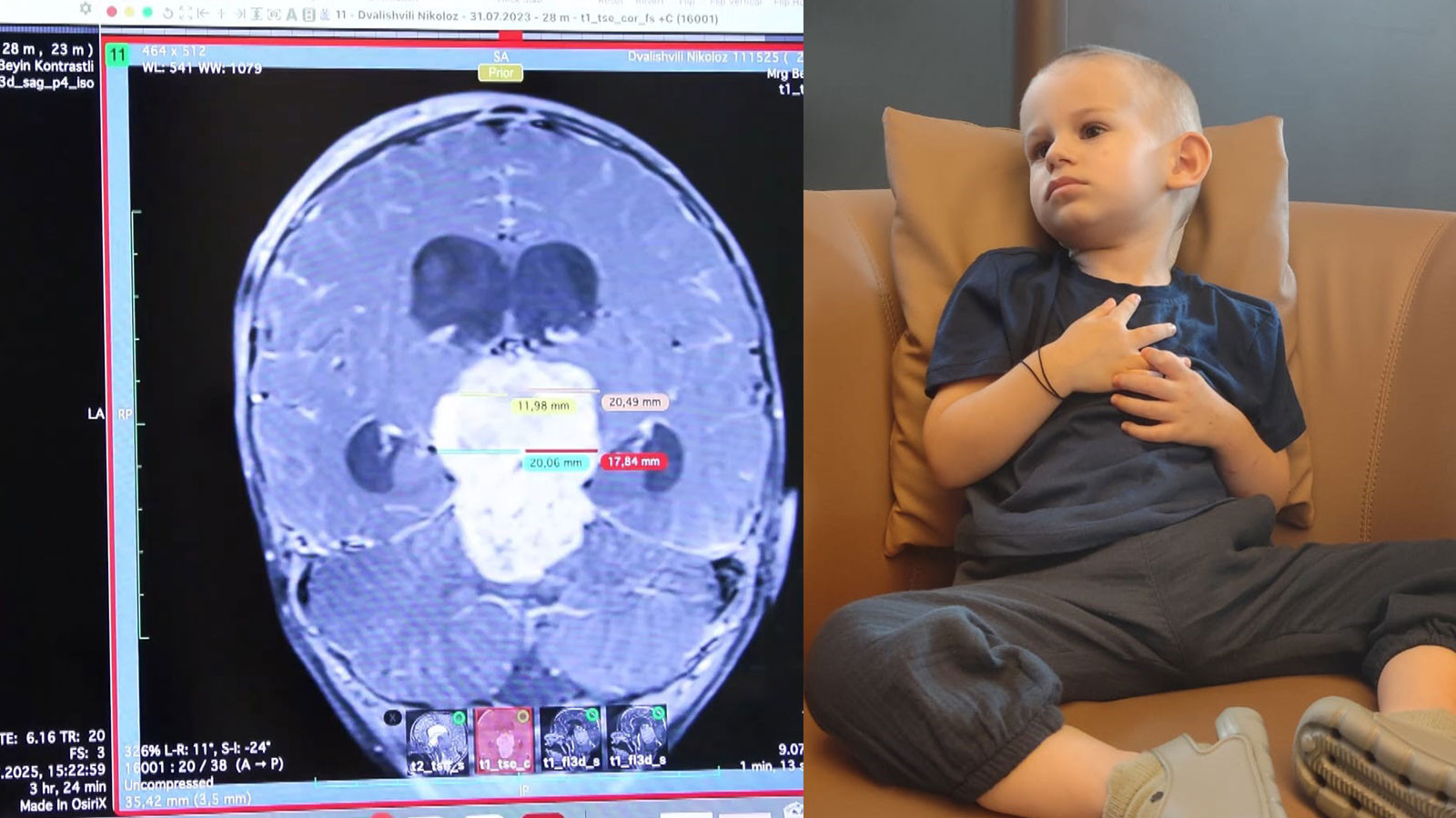 2,5 yaşındaki Nikoloz’un beyninden 7 santimetrelik tümör çıkarıldı