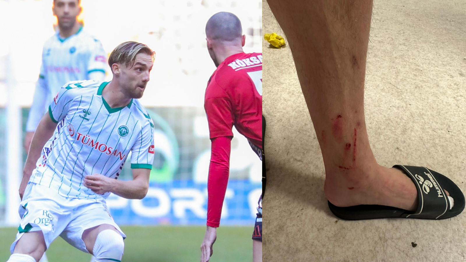 Berkan Kutlu ayağının son halini paylaştı! Taraftar isyan etti