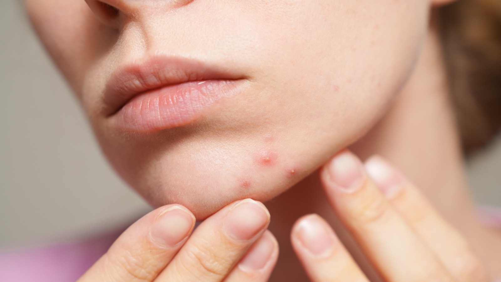 Sivilcelerden kurtulmak isteyenlere bayram ettirecek doğal çözüm