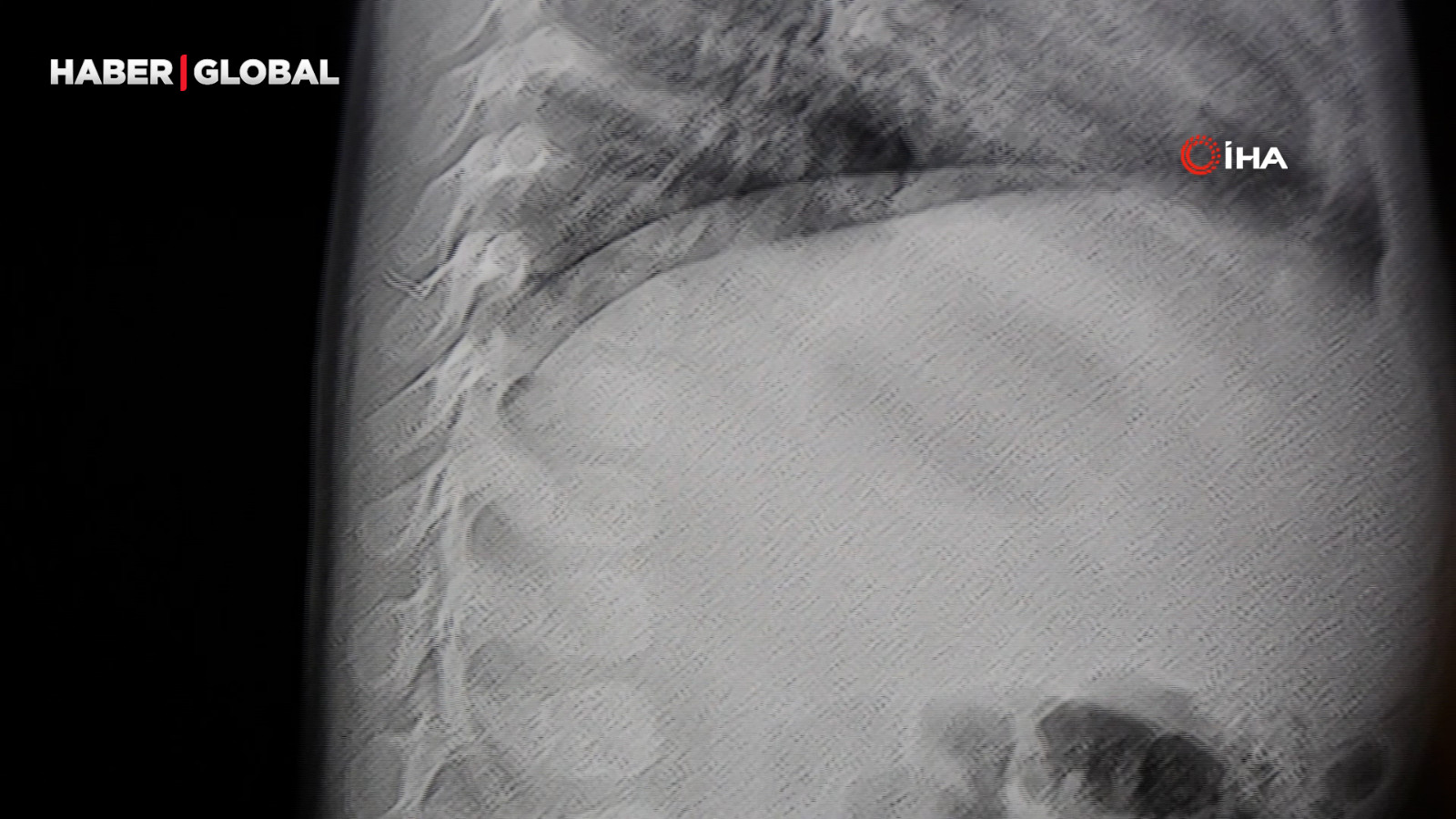 Kahramanmaraş'ta bebeğin sırtından çıkarılan yabancı cisim şoke etti!
