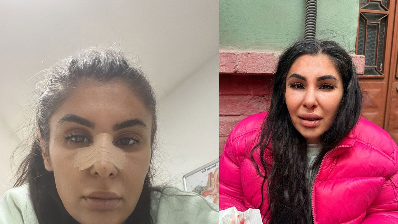 İlişkisini bitirmek istedi darbedilip burnu kırıldı: Yaşamak istiyorum