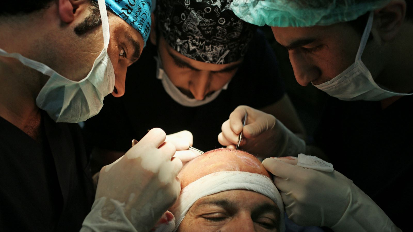 Saç ektirmek için neden Türkiye'yi tercih ediyorlar?