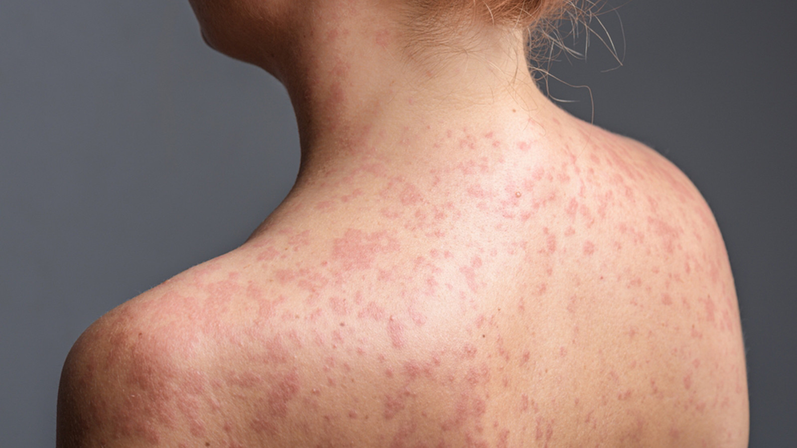 İstanbul'da yeni salgın: Vakalar giderek artıyor! Yetişkinlerde de görülüyor