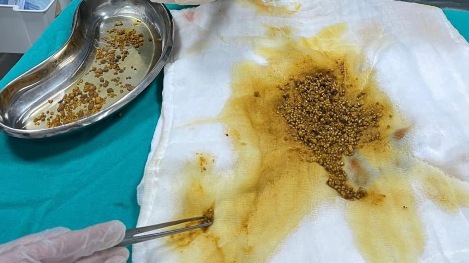 Safra kesesi ameliyatında doktoru bile şaşırtan olay! 'İlk kez gördüm'