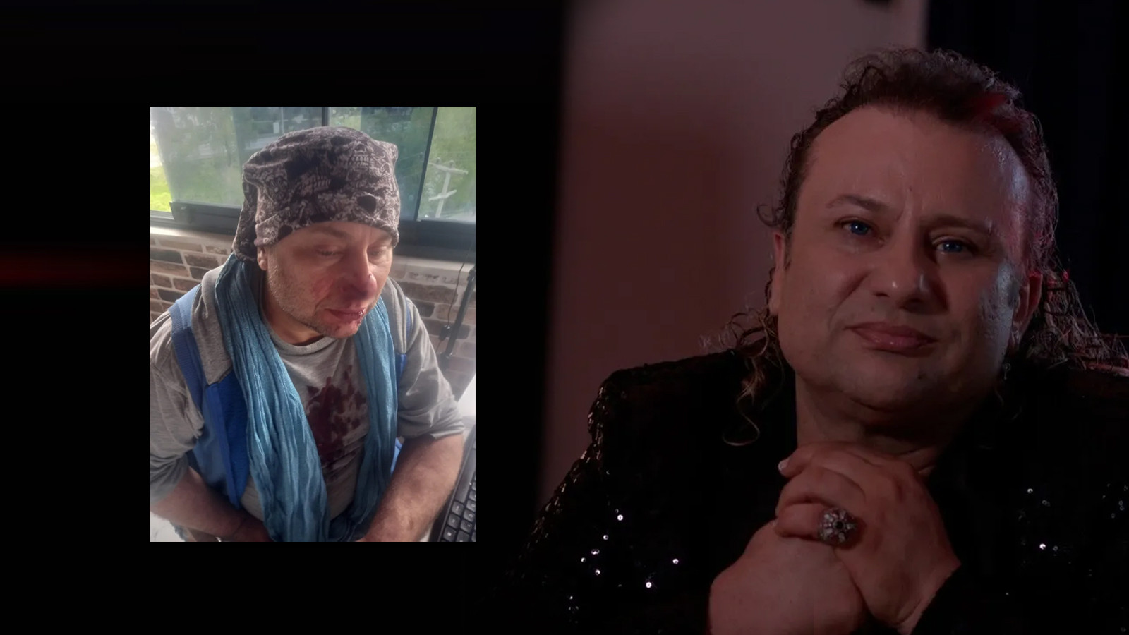 Ünlü isim pitbul saldırısına uğradı; burnu parçalandı!