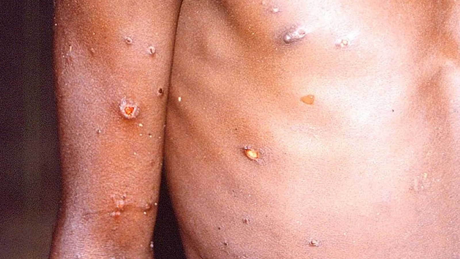 Gana'da M çiçeği vaka sayısı 1062'ye yükseldi