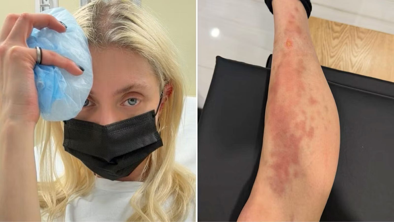 Zehirli örümceğin ısırdığı ünlü şarkıcı hastanelik oldu: Etimden bir parça eksildi