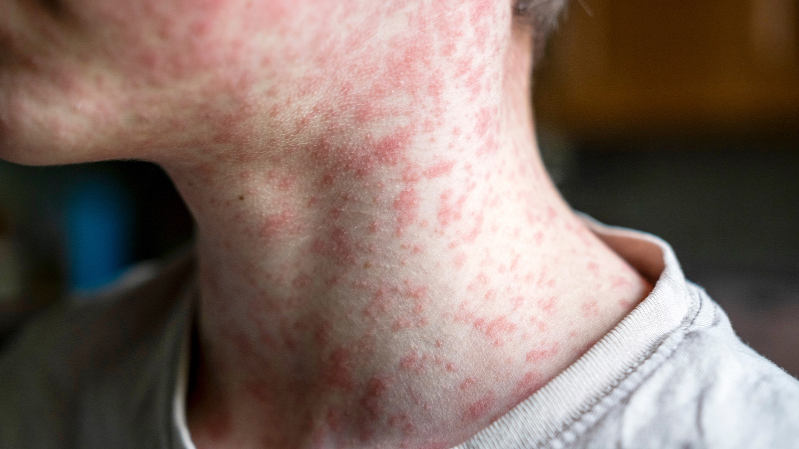 Çocukluk hastalığı geri döndü! Kızamık vakaları korkutuyor