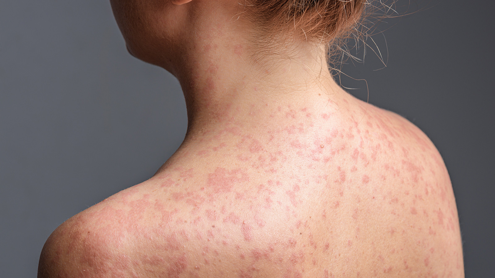 Prof. Dr. Ateş Kara'dan kızamık uyarısı! Vakalar artıyor, Bir kişi 18 kişiye bulaştırabilir