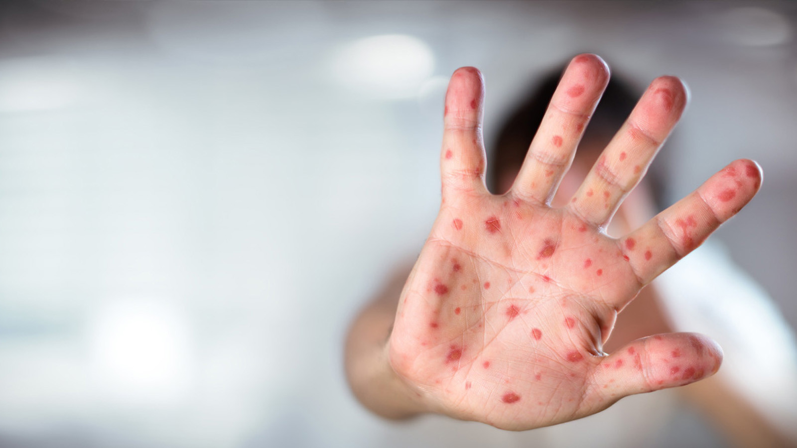 Kalabalık ortamlardan uzak durun, hızla yayılıyor: Aşı hayati önem taşıyor