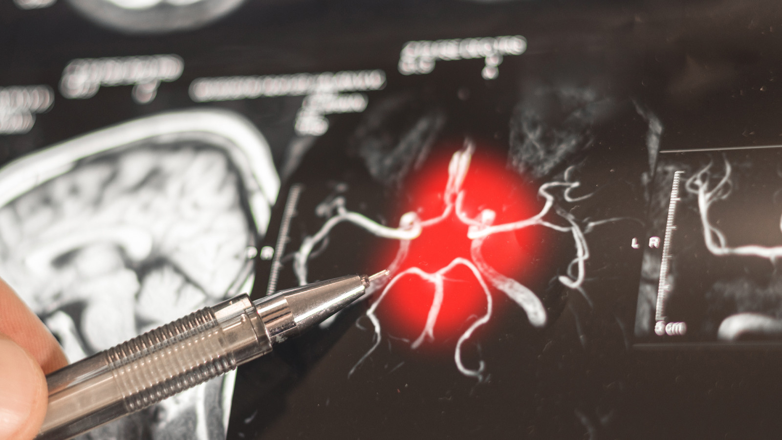 Alzheimer’da 'gizli evre' keşfedildi: Belirtiler 50’li yaşlarda başlıyor!