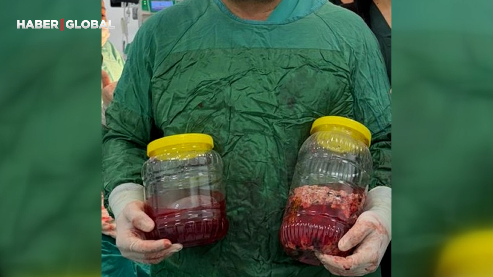 Sürekli zayıflayan hastanın böbreğinden 20 santimlik tümör çıkarıldı